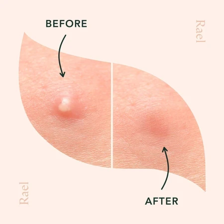 Rael Pimple Patches Acne Healing Patch 13.jpg