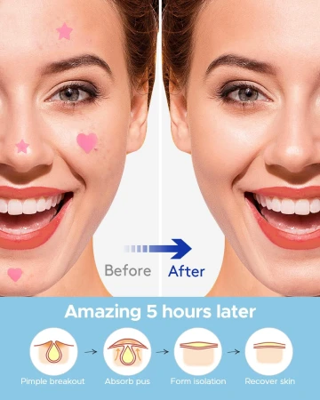 Acne Patch Pimple Patch, LitBear Pink Heart &amp; Star Shaped Acne Absorbing Spot Patches 14.jpg