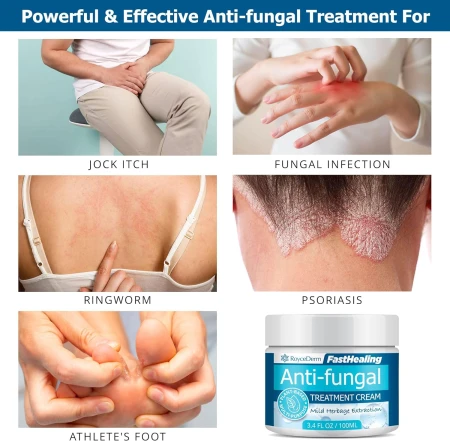 Roycederm Antifungal Cream for Skin Extra Strength Fast Relief 2.jpg